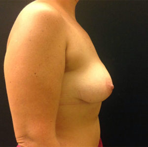 Breast Augmentation