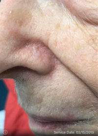 Basal Cell Carcinoma