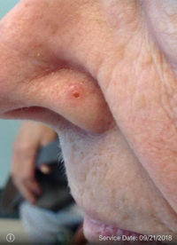 Basal Cell Carcinoma