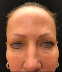 Upper Eyelid Blepharoplasty