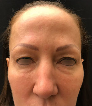 Upper Eyelid Blepharoplasty