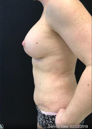 Tummy Tuck