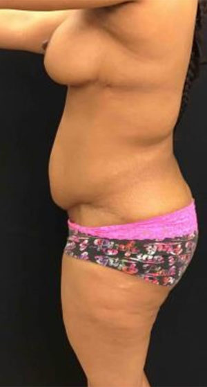 Tummy Tuck