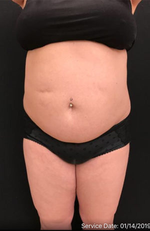 Liposuction