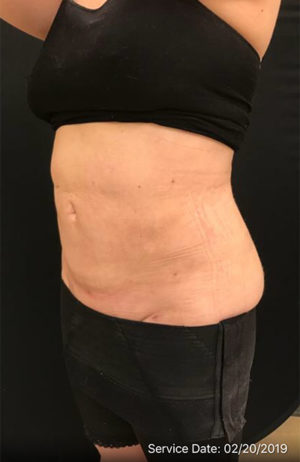 Liposuction