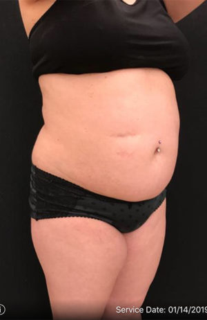 Liposuction