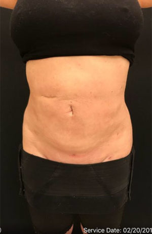 Liposuction