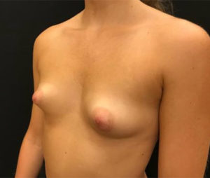 Breast Augmentation