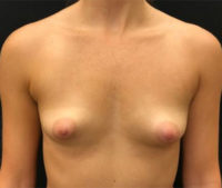 Breast Augmentation