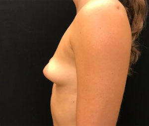 Breast Augmentation