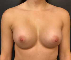 Breast Augmentation