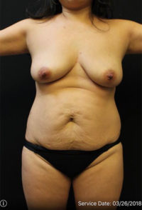 Tummy Tuck