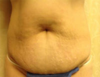 Tummy Tuck