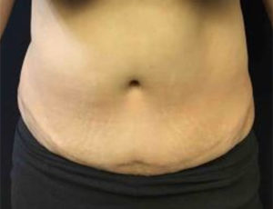 Tummy Tuck