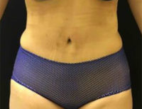 Tummy Tuck