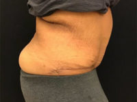 Tummy Tuck