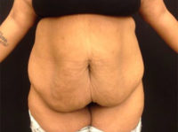 Tummy Tuck