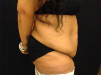 Tummy Tuck