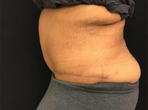 Tummy Tuck