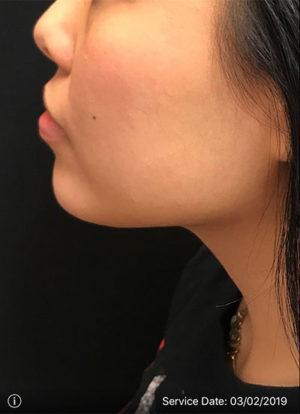 Chin Rejuvenation