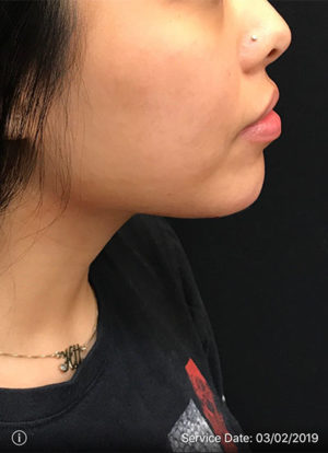 Chin Rejuvenation