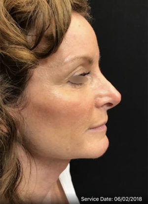 Nose Rejuvenation