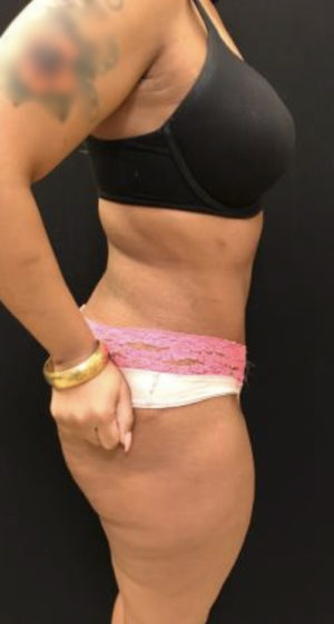 Tummy Tuck