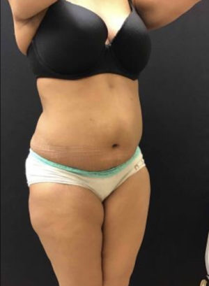 Tummy Tuck