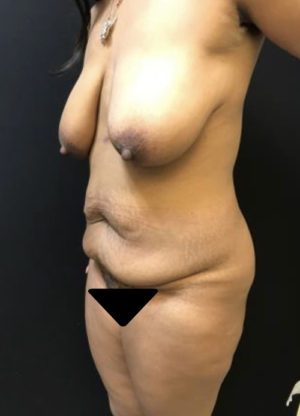 Tummy Tuck