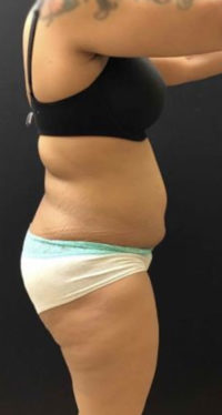 Tummy Tuck