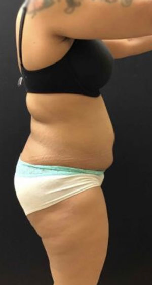 Tummy Tuck