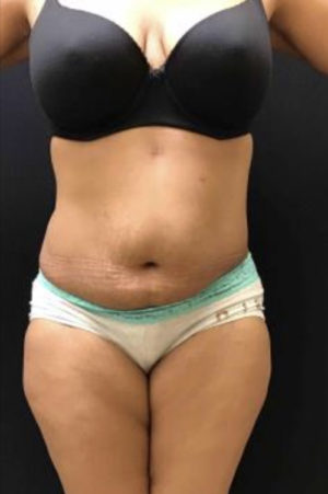 Tummy Tuck