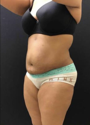 Tummy Tuck