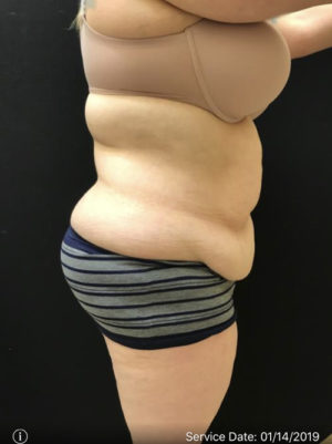 Tummy Tuck