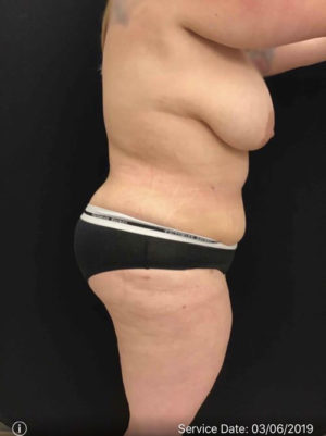 Tummy Tuck