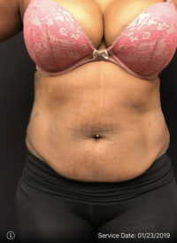 Liposuction