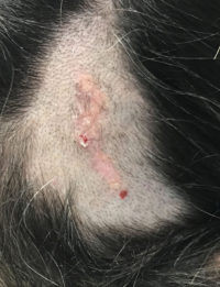 Basal Cell Carcinoma