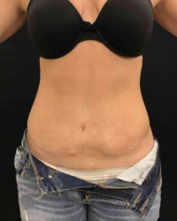 Liposuction