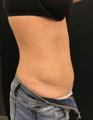 Liposuction