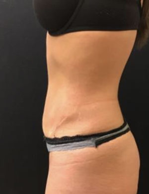 Liposuction