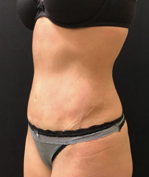 Liposuction