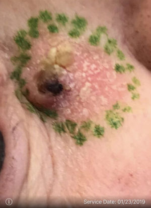 Squamous Cell Carcinoma