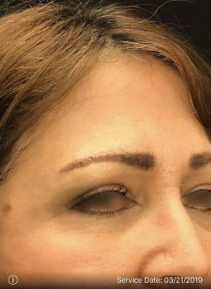 Upper Eyelid Blepharoplasty