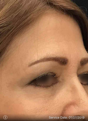 Upper Eyelid Blepharoplasty