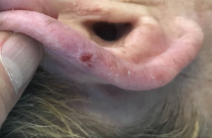 Basal Cell Carcinoma