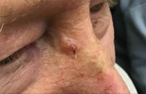 Basal Cell Carcinoma