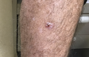 Basal Cell Carcinoma