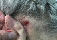 Basal Cell Carcinoma