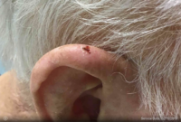 Basal Cell Carcinoma