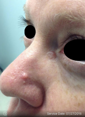 Basal Cell Carcinoma